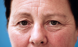 Verouderingsverschijnselen in het aangezicht en cosmetische aangezichtschirurgie