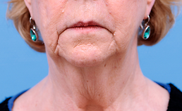 Verouderingsverschijnselen in het aangezicht en cosmetische aangezichtschirurgie