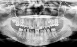 Preprothetische orthodontische behandelingen