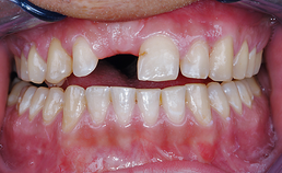 Preprothetische orthodontische behandelingen