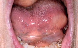 Unilateraal angio-oedeem van de tong en de mondbodem door ACE-remmers