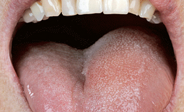 Unilateraal angio-oedeem van de tong en de mondbodem door ACE-remmers