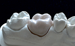 Tandtechnische aspecten van de vervaardiging van kronen en bruggen