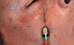 Vettransplantatie in de cosmetische aangezichtschirurgie