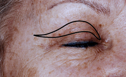 Ooglidcorrecties in de cosmetische aangezichtschirurgie