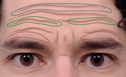Liftingprocedures in de cosmetische aangezichtschirurgie