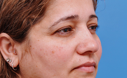 Liftingprocedures in de cosmetische aangezichtschirurgie