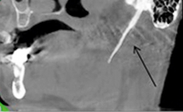 Parasagittale doorsnede CBCT: verkalke ligamentum stylohyoideum