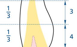 Schematische weergave occlusale/incisale vijfpuntenschaal in een tand