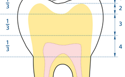 Schematische weergave van de occlusale/incisale vijfpuntenschaal in een molaar