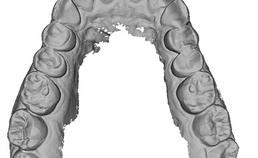 3D-scan ernstige gebitsslijtage bovenkaak, intake