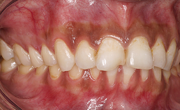 beethoogteverlies, verdiepte frontrelatie, schade aan parodontium 