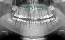 röntgenologisch beeld voor voltooiing orthodontische behandeling