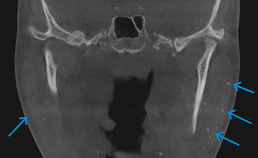 CBCT-scan met multipele intraglandulair gelegen kalkspatten
