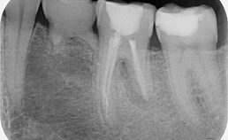 Gebitselement 36 na endodontische behandeling