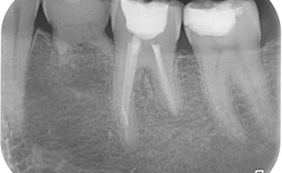 Gebitselement 36 1 jaar na afronden van de endodontische behandeling