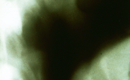 Röntgenologisch beeld van mandibulaire retrognathie met normale kaakkopjes