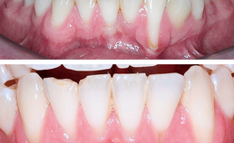 Onderkaak voor en 4,5 jaar na orthodontische behandeling van gingivarecessie
