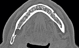 Axiale coupe toont sclerotisch defect in mandibula rechts linguaal.