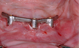Hyperplasie van gingiva onder mesostructuur