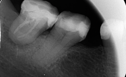 Endodontisch behandelt gebitselement met  parodontitis apicalis
