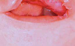 unilaterale cheilognatopalataloschisis; postnataal frontaal