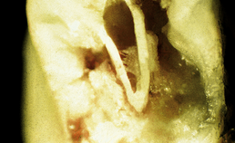 dwarsdoorsnede cervicale wortelresorptie