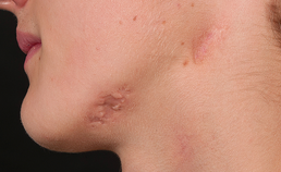 verlittekende huid na niet-tuberculeuze mycobacteriële lymfadenitis