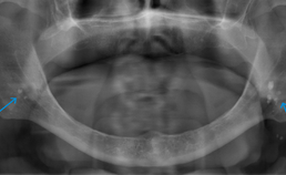 opt met multipele, dubbelzijdig voorkomende opaciteiten over ramus mandibulae