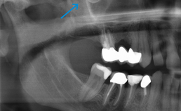 Scherp begrensde opaciteit ter plekke van de rechter sinus maxillaris