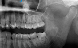 Opaciteit ter plekke van de linker sinus maxillaris