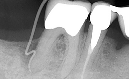 wortelkanaalbehandeling bij parodontitis apicalis