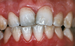 Coeliakie en tandheelkunde