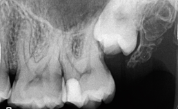 Endodontologie in beweging: nieuwe concepten, materialen en technieken 2. Conebeamcomputer­tomografie in de endodontische diagnostiek en behandelplanning