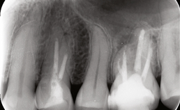 Endodontologie in beweging: nieuwe concepten, materialen en technieken 2. Conebeamcomputer­tomografie in de endodontische diagnostiek en behandelplanning