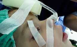 Neurotoxiciteit van sedativa en anesthetica bij jonge kinderen