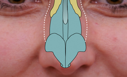 Schematische weergave van humpreductie van neusbrug