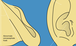 Schematische weergave van een afstaand oor