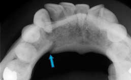 Occlusale röntgenopname toont paramediane mandibulafractuur en angulusfractuur
