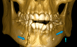 CBCT toont paramediane mandibulafractuur en angulusfractuur