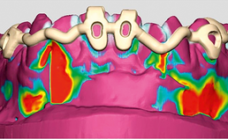 Digitale ontwerp van driedimensionaal geprinte dentale spalk