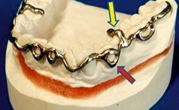 Driedimensionaal geplande en in chroom-cobalt geprinte dentale spalk 