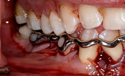 Driedimensionaal geprinte dentale spalk in situ