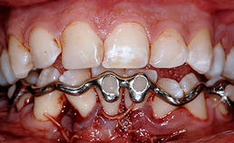 Driedimensionaal geprinte dentale spalk in situ; occlusie hersteld