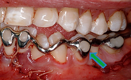 Driedimensionaal geprinte dentale spalk gefixeerd met composiet