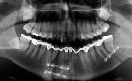 Standscorrectie van de mandibula met de driedimensionaal geprinte dentale spalksitu.