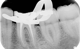 Na endodontische behandeling: periapicale radiolucentie