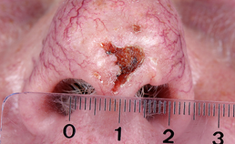Basaalcelcarcinoom op neus 2