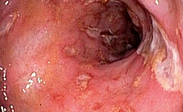 Mucosa met ulceraties