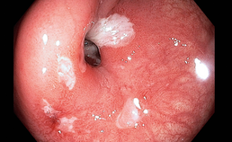 Stenose van het colon met ulcera